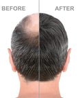 Minoxidil Hair Regrowth Treatment