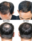 Minoxidil Hair Regrowth Treatment